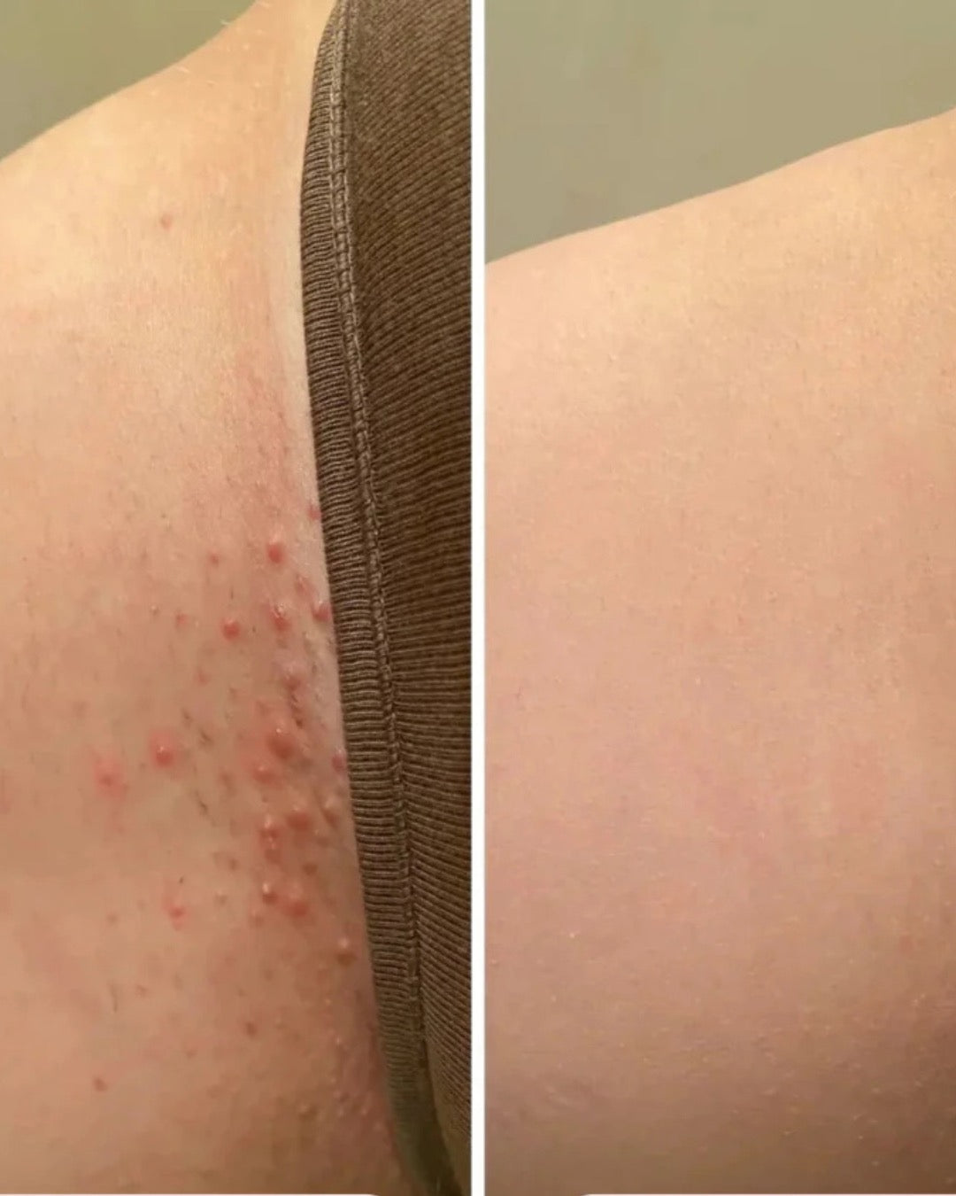 2-In-1 Trimmer | Anti-Ingegroeide Haren
